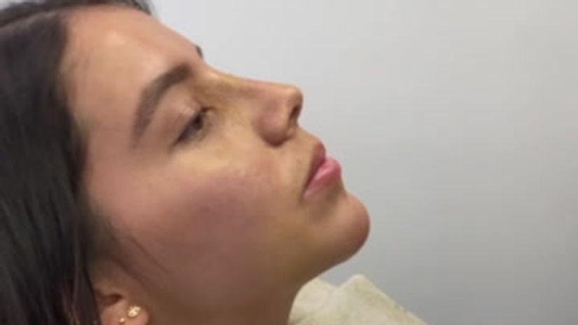 Caso rinoplastia